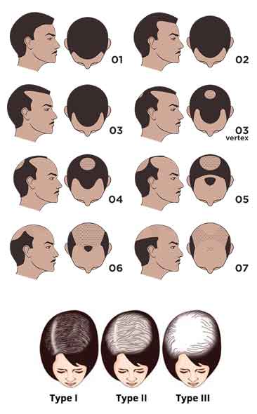 hereditary hair loss progression