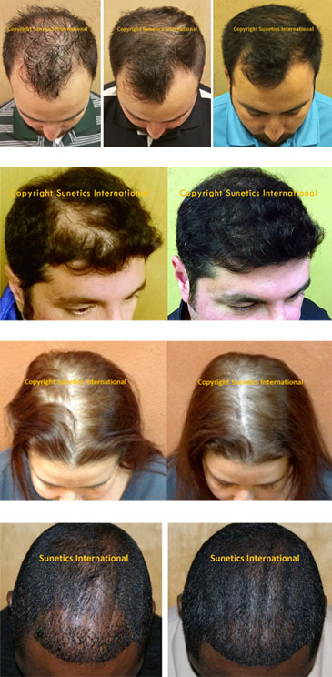 laser hair growth therapy specialist lexington kentucky