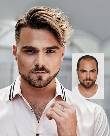 Lexington Mens Hair Restoration