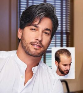 mens non-surgical hair replacement restoration lexington kentucky