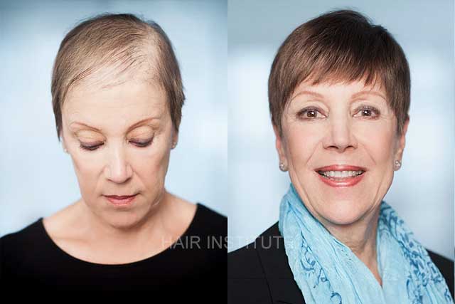 Proven Women's Hair Loss Solutions - Hair Institute