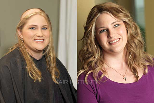 Women's Hair Restoration Lexington Kentucky