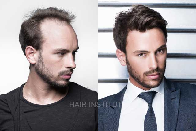 Men's Hair Restoration Results - Lexington KY