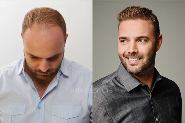 Custom Men's Hair Replacement - Lexington KY