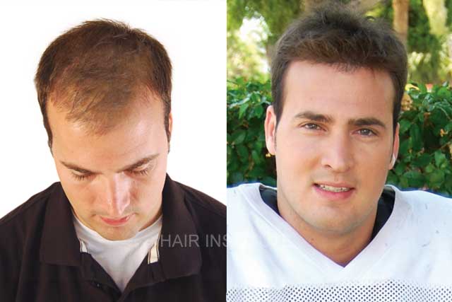 Men's Non-Surgical Hair Replacement - Hair Institute